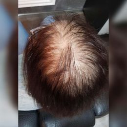Traumhafte Haarverdichtung: Ergebnisse mit Krankenkassenzuschuss – Wir kümmern uns!